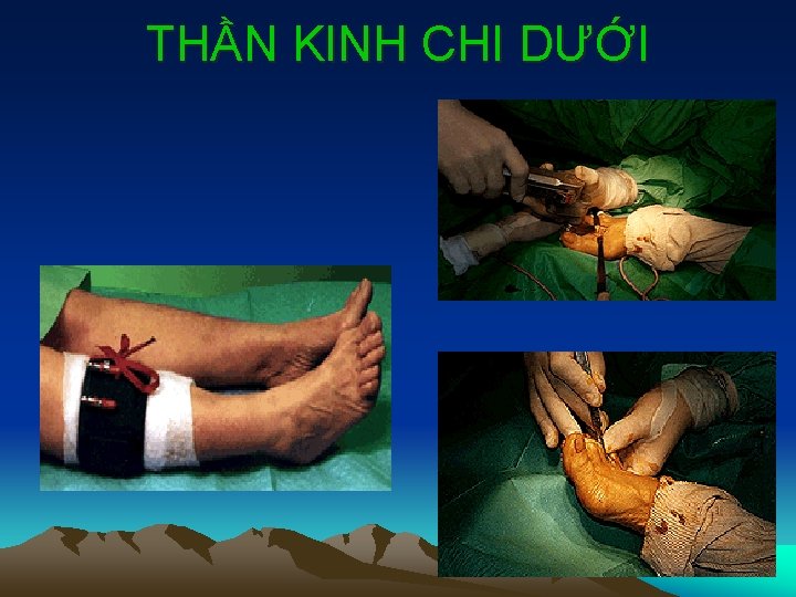 THẦN KINH CHI DƯỚI 