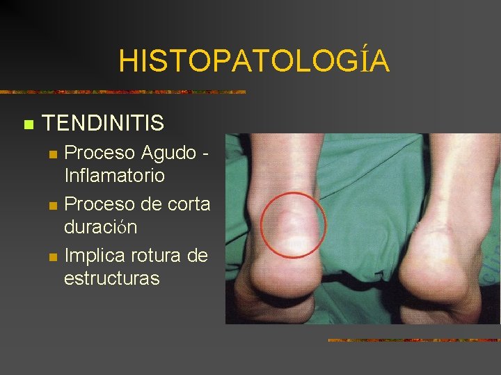 HISTOPATOLOGÍA n TENDINITIS n n n Proceso Agudo Inflamatorio Proceso de corta duración Implica