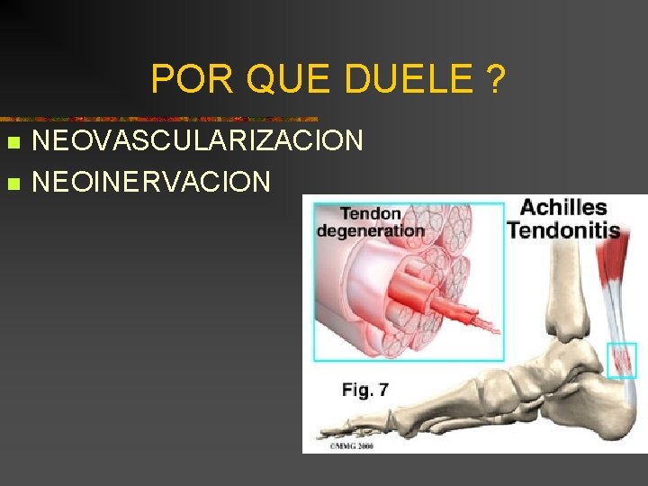 POR QUE DUELE ? n n NEOVASCULARIZACION NEOINERVACION 