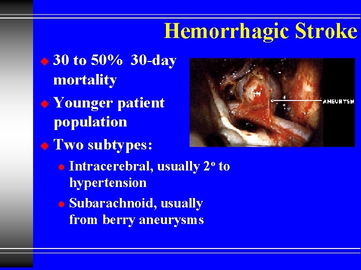 Hemorrhagic Stroke 30 to 50% 30 -day mortality u Younger patient population u Two