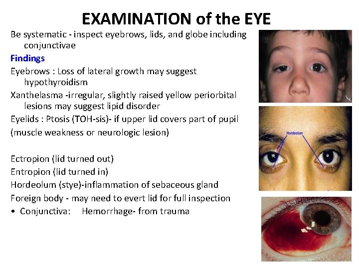 EXAMINATION of the EYE Be systematic - inspect eyebrows, lids, and globe including conjunctivae