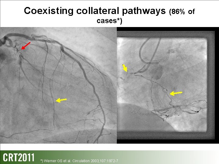 Coexisting collateral pathways (86% of cases*) *) Werner GS et al. Circulation 2003; 107: