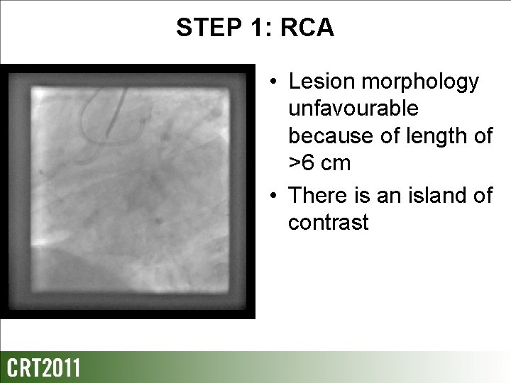 STEP 1: RCA • Lesion morphology unfavourable because of length of >6 cm •