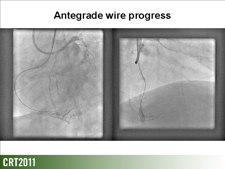 Antegrade wire progress 