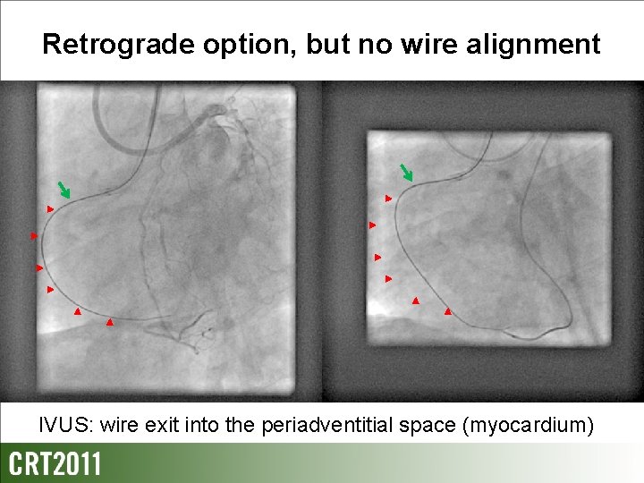 Retrograde option, but no wire alignment IVUS: wire exit into the periadventitial space (myocardium)
