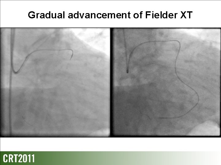 Gradual advancement of Fielder XT 