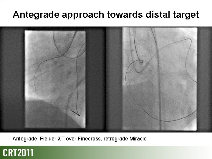 Antegrade approach towards distal target Antegrade: Fielder XT over Finecross, retrograde Miracle 