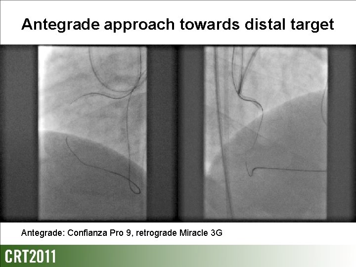 Antegrade approach towards distal target Antegrade: Confianza Pro 9, retrograde Miracle 3 G 