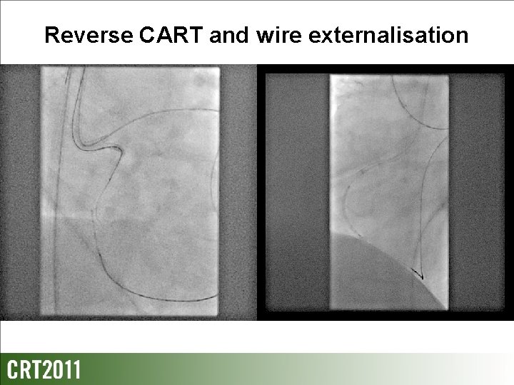 Reverse CART and wire externalisation Reverse CART and wire externalisation