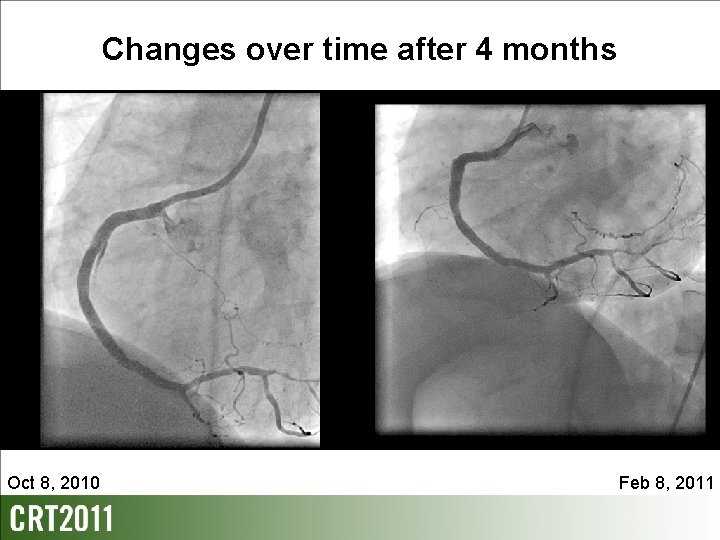 Changes over time after 4 months Oct 8, 2010 Feb 8, 2011 