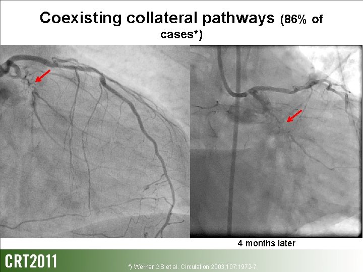 Coexisting collateral pathways (86% of cases*) 4 months later *) Werner GS et al.