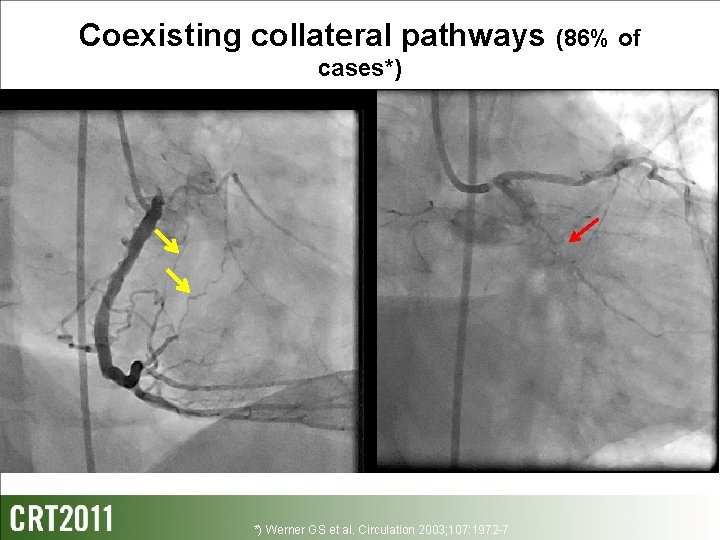 Coexisting collateral pathways (86% of cases*) *) Werner GS et al. Circulation 2003; 107: