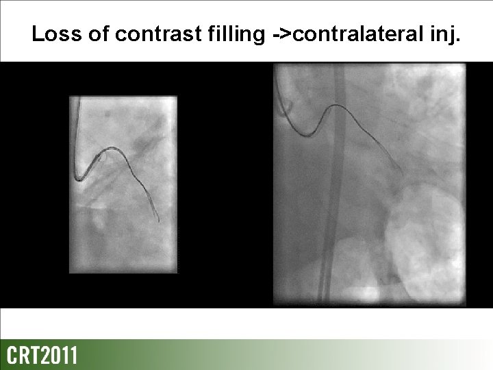 Loss of contrast filling ->contralateral inj. 