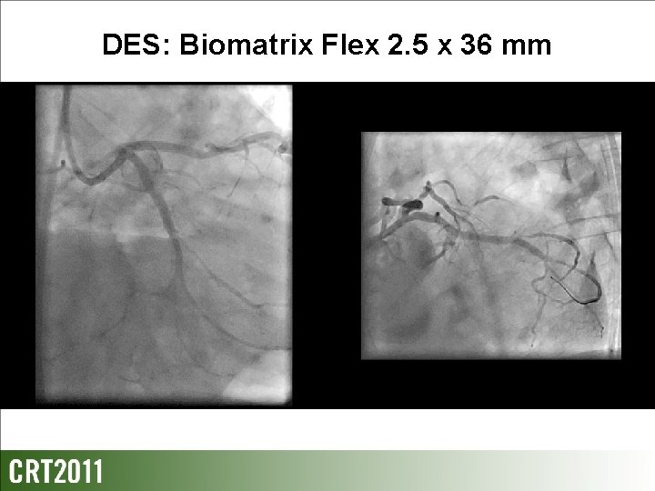 DES: Biomatrix Flex 2. 5 x 36 mm 