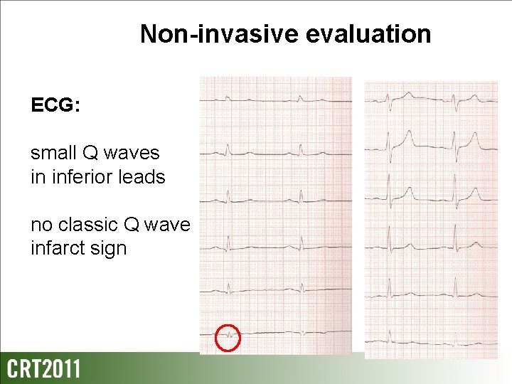 Non-invasive evaluation ECG: small Q waves in inferior leads no classic Q wave infarct