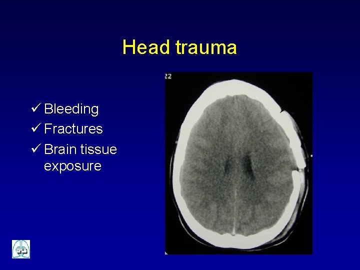 Head trauma ü Bleeding ü Fractures ü Brain tissue exposure 