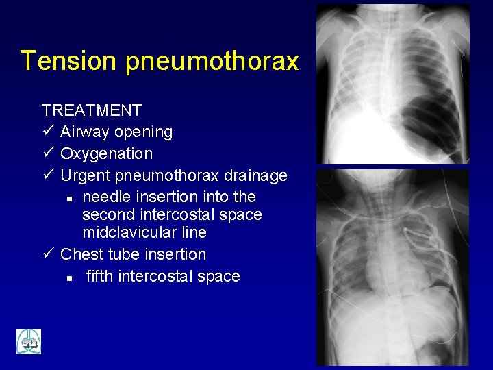 Tension pneumothorax TREATMENT ü Airway opening ü Oxygenation ü Urgent pneumothorax drainage n needle