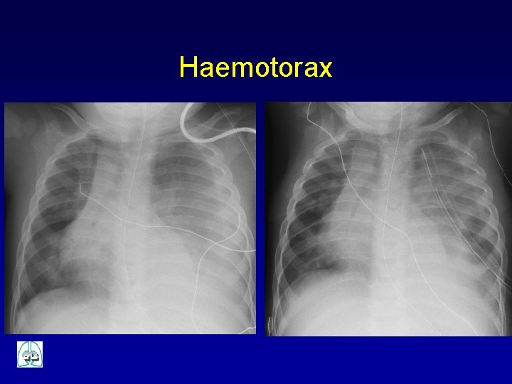 Haemotorax 