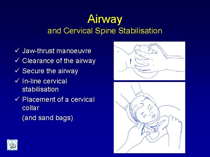 Airway and Cervical Spine Stabilisation ü ü Jaw-thrust manoeuvre Clearance of the airway Secure