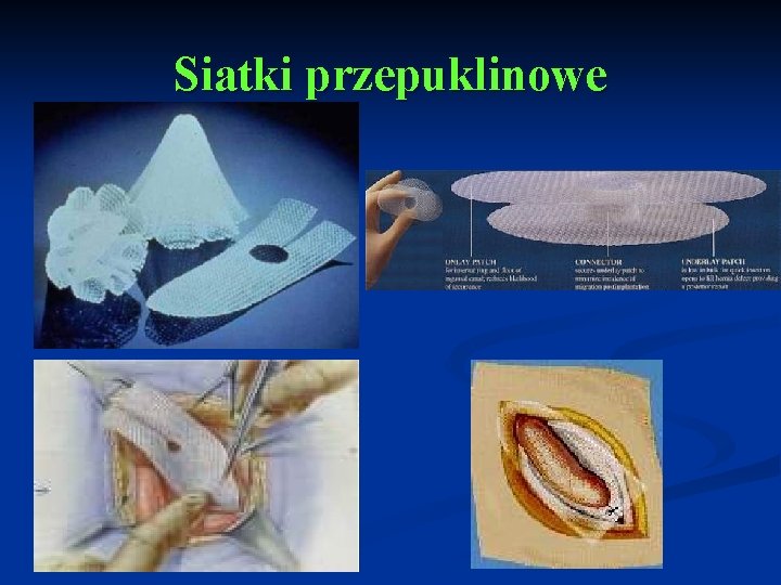 Siatki przepuklinowe 