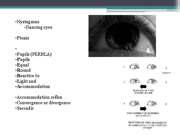 • Nystagmus • Dancing eyes • Ptosis • • Pupils (PERRLA) • Pupils • Nystagmus • Dancing eyes • Ptosis • • Pupils (PERRLA) • Pupils