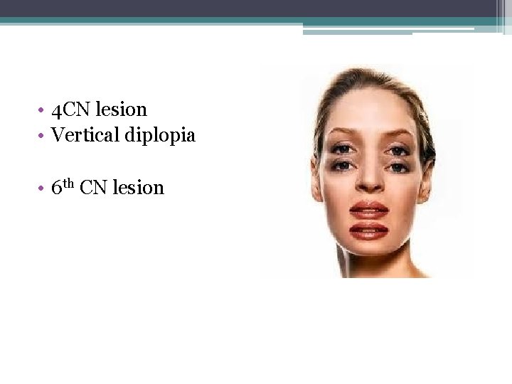 • 4 CN lesion • Vertical diplopia • 6 th CN lesion • 4 CN lesion • Vertical diplopia • 6 th CN lesion