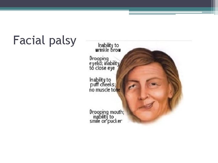 Facial palsy Facial palsy