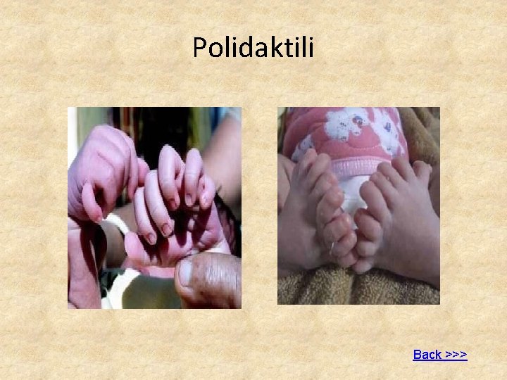 Polidaktili Back >>> 