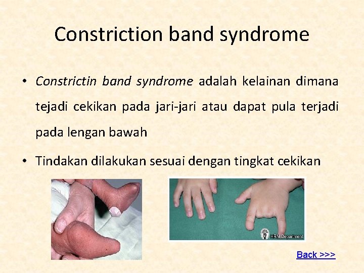 Constriction band syndrome • Constrictin band syndrome adalah kelainan dimana tejadi cekikan pada jari-jari