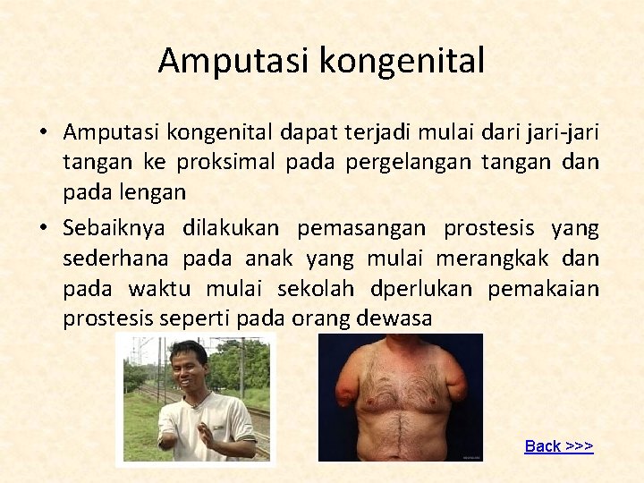  Amputasi kongenital • Amputasi kongenital dapat terjadi mulai dari jari-jari tangan ke proksimal