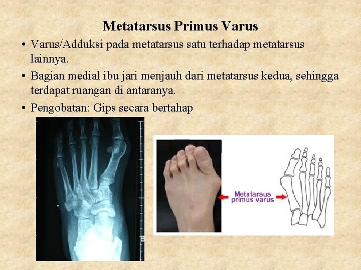 Metatarsus Primus Varus • Varus/Adduksi pada metatarsus satu terhadap metatarsus lainnya. • Bagian medial