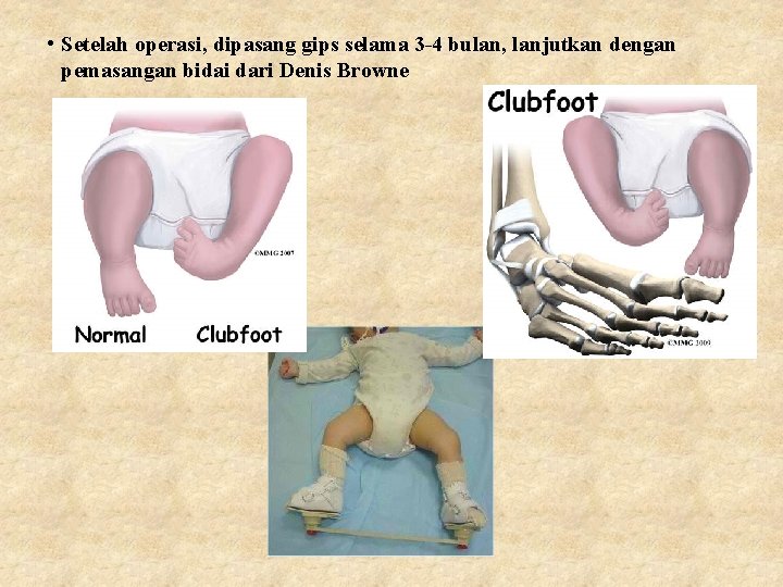  • Setelah operasi, dipasang gips selama 3 -4 bulan, lanjutkan dengan pemasangan bidai