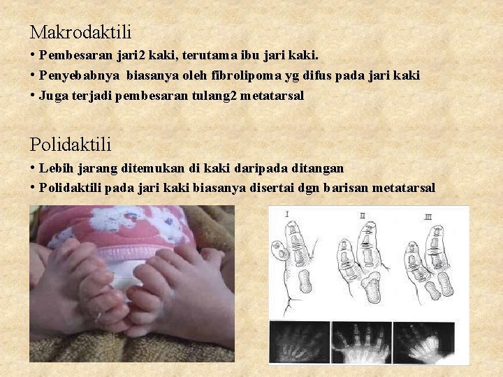 Makrodaktili • Pembesaran jari 2 kaki, terutama ibu jari kaki. • Penyebabnya biasanya oleh