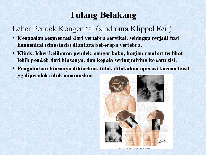 Tulang Belakang Leher Pendek Kongenital (sindroma Klippel Feil) • Kegagalan segmentasi dari vertebra servikal,