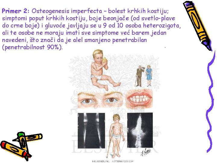 Primer 2: Osteogenesis imperfecta – bolest krhkih kostiju; simptomi poput krhkih kostiju, boje beonjače