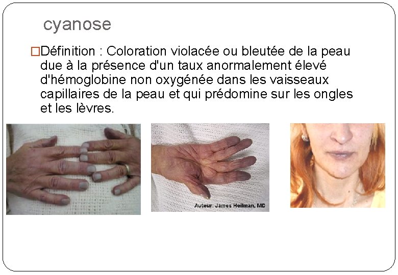 cyanose �Définition : Coloration violacée ou bleutée de la peau due à la présence