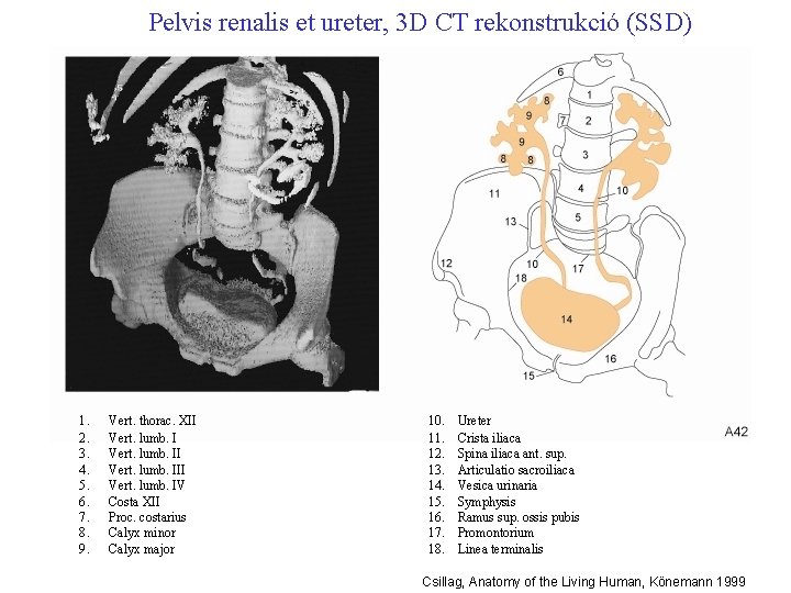 Pelvis renalis et ureter, 3 D CT rekonstrukció (SSD) 1. 2. 3. 4. 5.