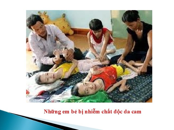 Những em bé bị nhiễm chất độc da cam 