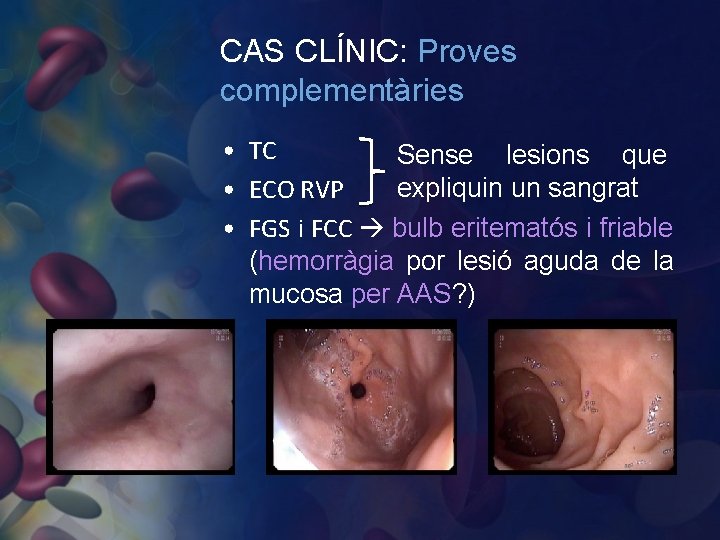 CAS CLÍNIC: Proves complementàries • TC Sense lesions que expliquin un sangrat • ECO