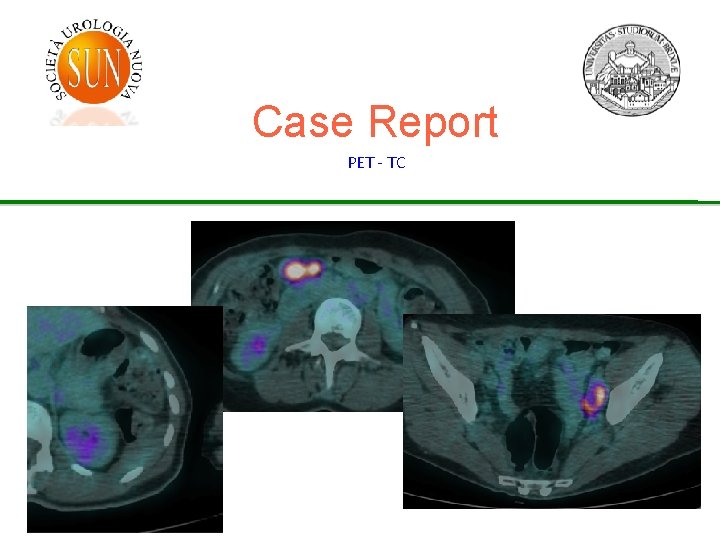 Case Report PET - TC 
