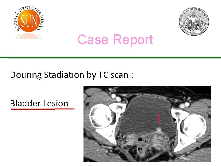 Case Report Douring Stadiation by TC scan : Bladder Lesion 