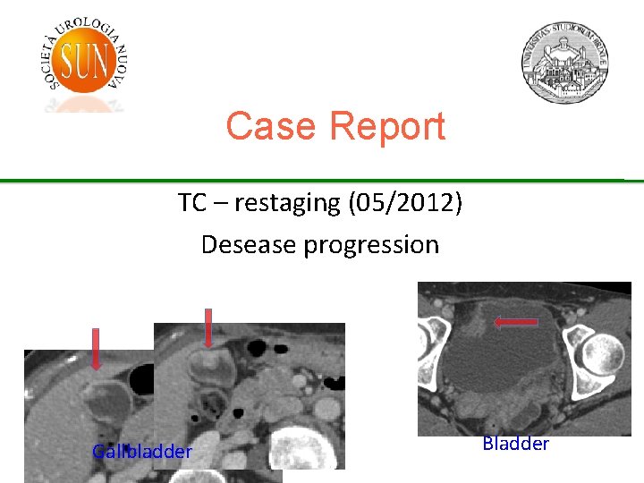 Case Report TC – restaging (05/2012) Desease progression Gallbladder Bladder 