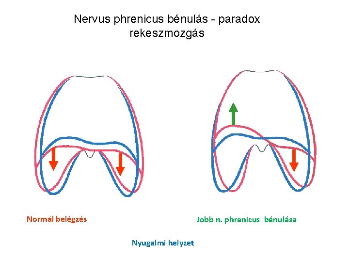 Nervus phrenicus bénulás - paradox rekeszmozgás Normál belégzés Jobb n. phrenicus bénulása Nyugalmi helyzet Nervus phrenicus bénulás - paradox rekeszmozgás Normál belégzés Jobb n. phrenicus bénulása Nyugalmi helyzet