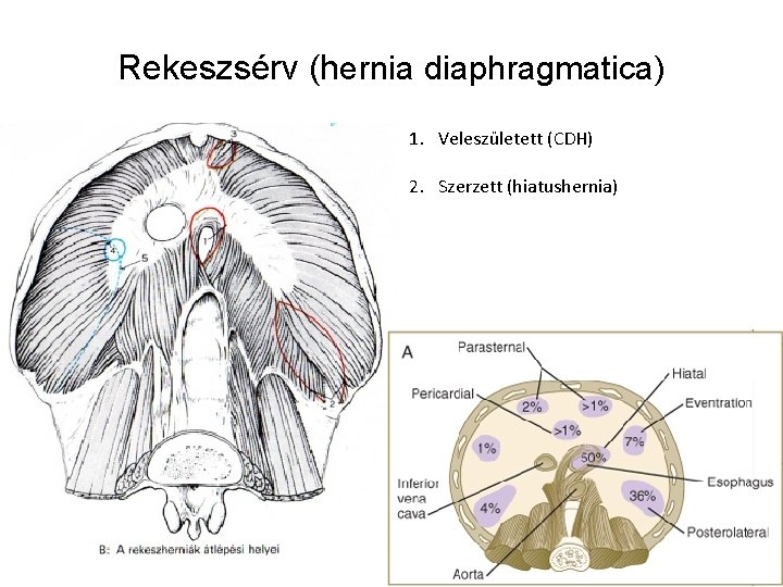Rekeszsérv (hernia diaphragmatica) 1. Veleszületett (CDH) 2. Szerzett (hiatushernia) Rekeszsérv (hernia diaphragmatica) 1. Veleszületett (CDH) 2. Szerzett (hiatushernia)