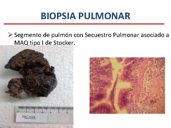 BIOPSIA PULMONAR Ø Segmento de pulmón con Secuestro Pulmonar asociado a MAQ tipo I