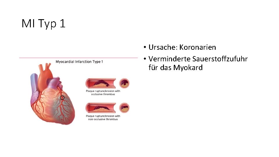 MI Typ 1 • Ursache: Koronarien • Verminderte Sauerstoffzufuhr für das Myokard 