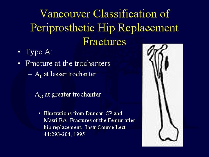 Vancouver Classification of Periprosthetic Hip Replacement Fractures • Type A: • Fracture at the