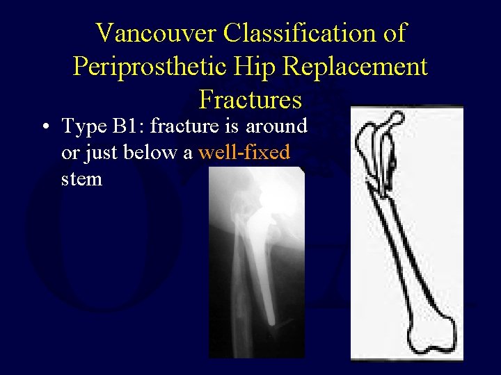 Vancouver Classification of Periprosthetic Hip Replacement Fractures • Type B 1: fracture is around