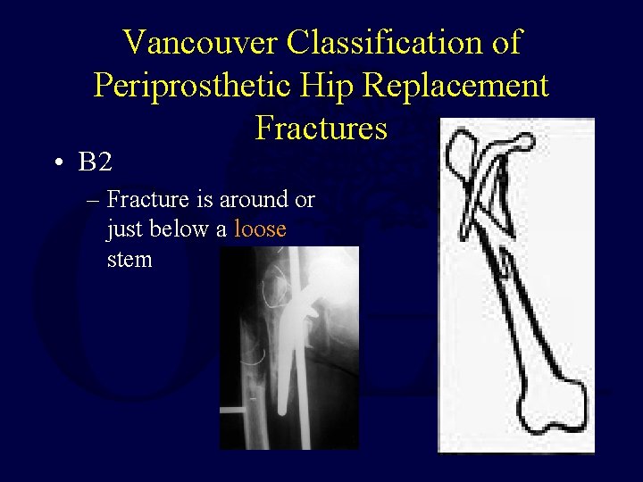 Vancouver Classification of Periprosthetic Hip Replacement Fractures • B 2 – Fracture is around