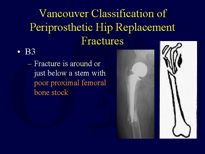 Vancouver Classification of Periprosthetic Hip Replacement Fractures • B 3 – Fracture is around